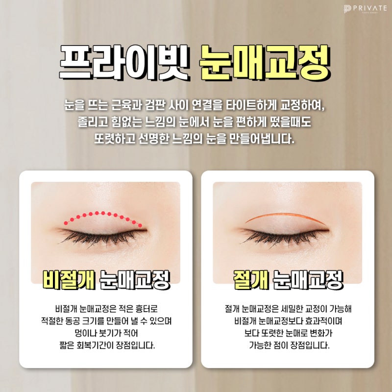 프라이빗성형외과 눈매교정수술 세밀한 변화를 위해 사진 4