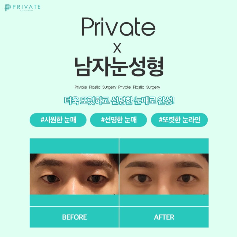 맞춤눈성형수술, 프라이빗성형외과 남자눈성형 사진 4