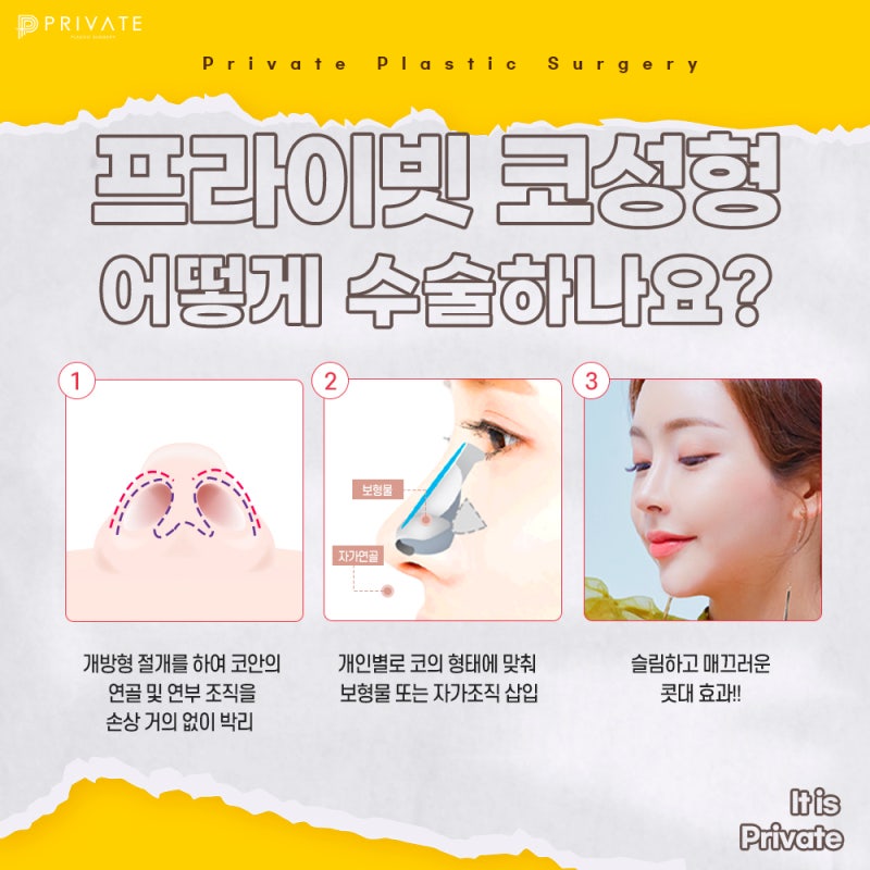 첫코성형수술 믿을수있는곳 프라이빗성형외과 사진 4