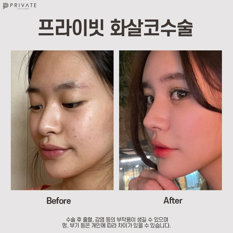 화살코수술 잘하는곳 프라이빗성형외과 사진 7