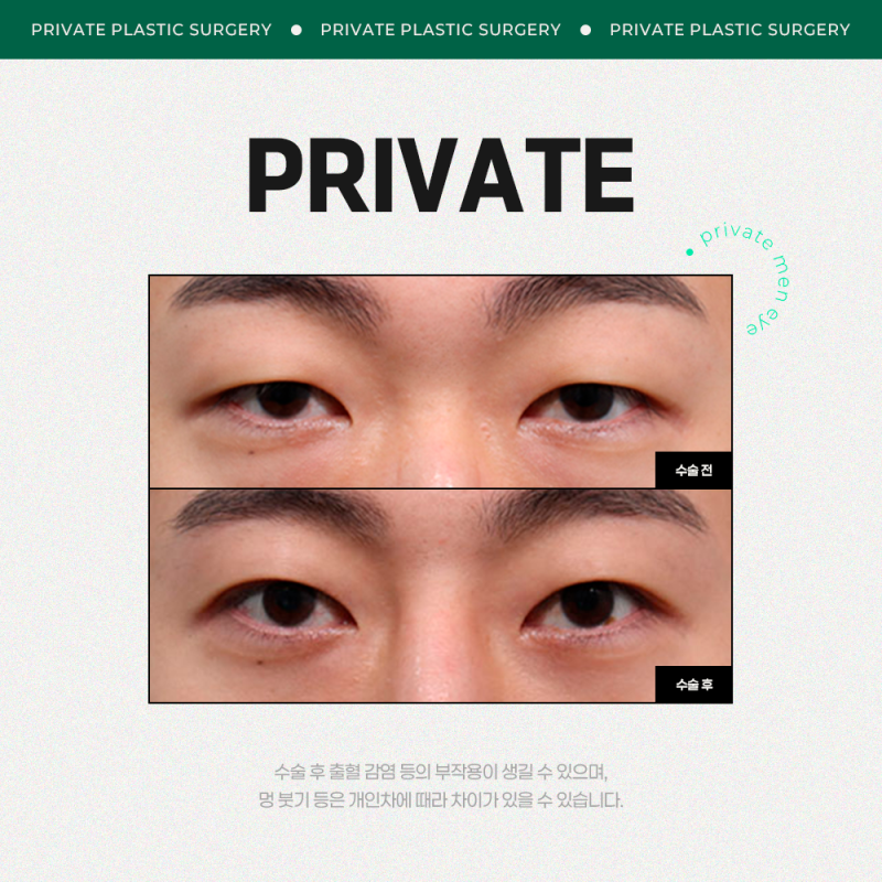 남자눈성형수술후기는 프라이빗성형외과 사진 6