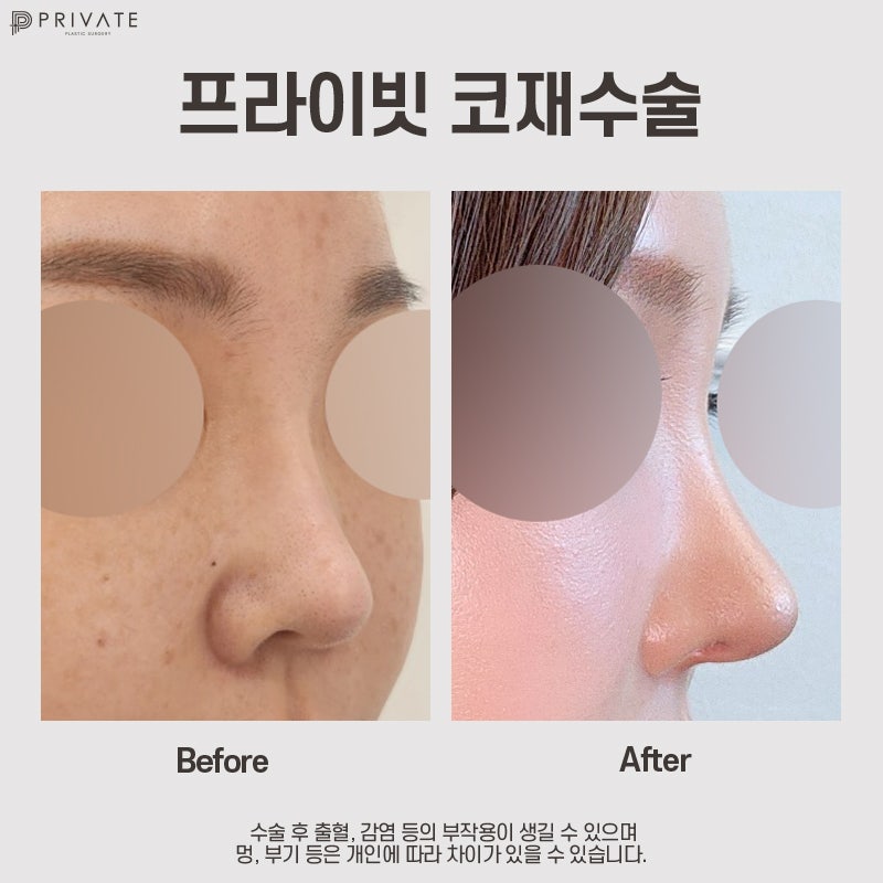 코재수술유명한병원은 프라이빗성형외과 사진 8