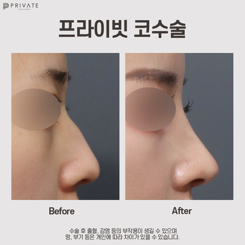 매부리코 깔끔하게 정리잘하는곳 프라이빗성형외과