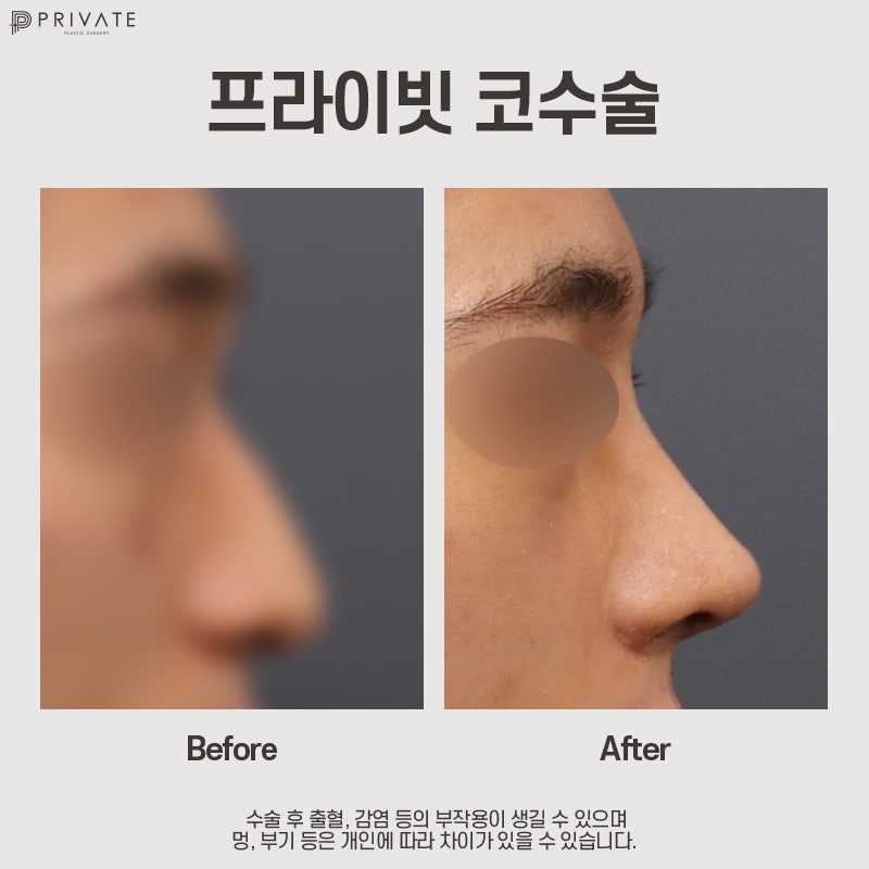 남자코성형잘하는곳 신사 프라이빗성형외과 사진 7