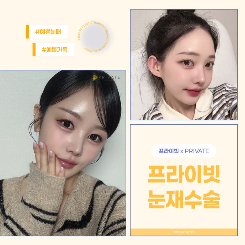 눈재수술성형은 신중하게, 프라이빗성형외과 사진 6