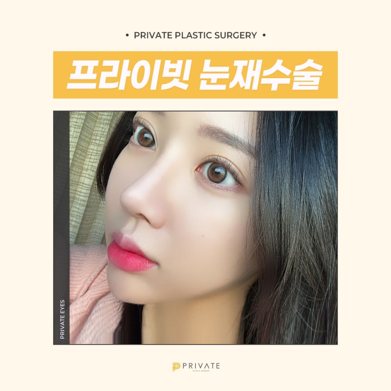 눈재수술성형은 신중하게, 프라이빗성형외과 사진 2