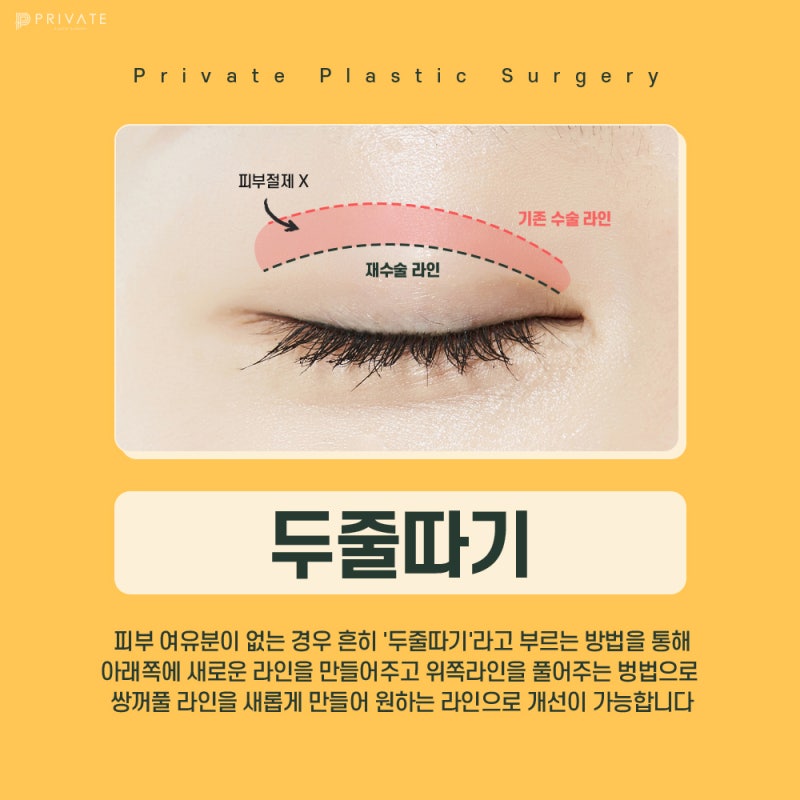 Operasi Revisi Kelopak Mata Insisi di Private Plastic Surgery 사진 5