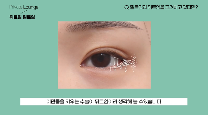 การผ่าตัดขยายหางตาและลดระดับหางตาที่ Private Plastic Surgery Clinic กับคุณหมออี จุน-อู 사진 9