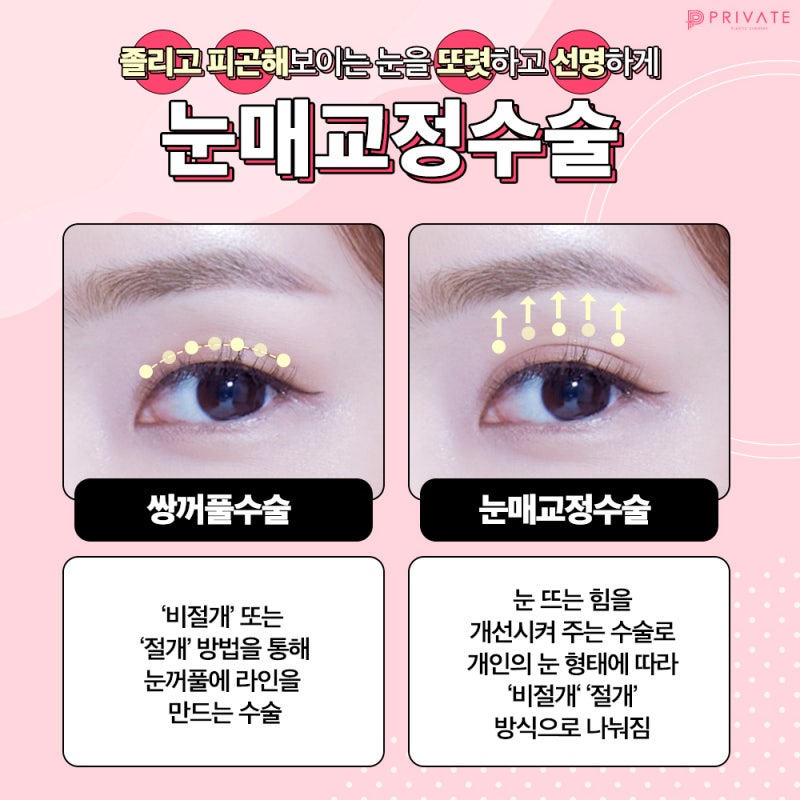 안검하수눈매교정은 프라이빗성형외과 사진 4