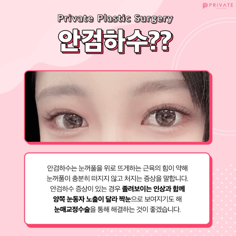 안검하수눈매교정은 프라이빗성형외과