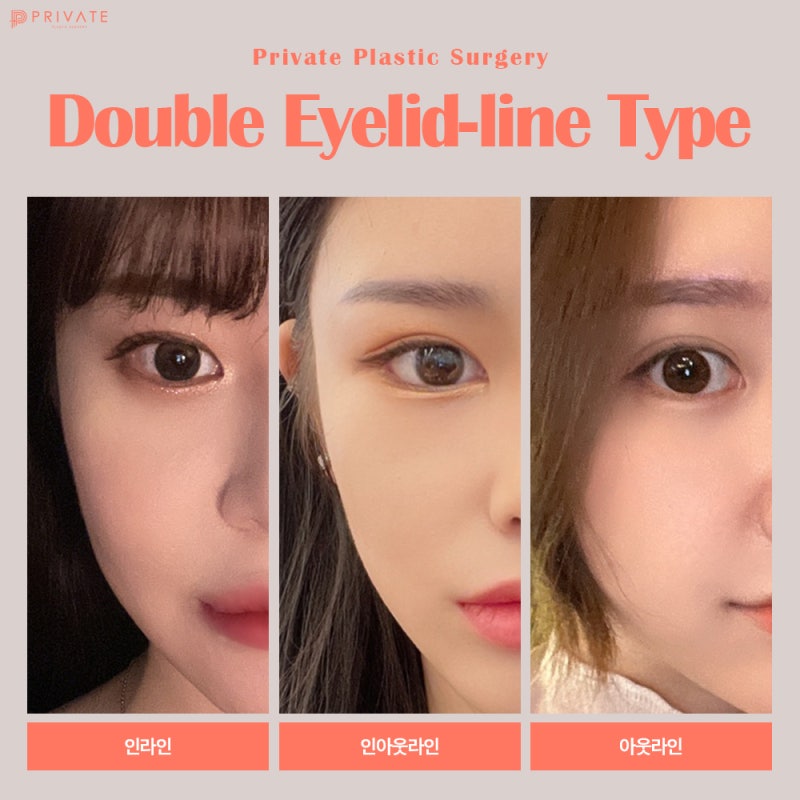 Tempat Bedah Mata Revisi yang Bagus, Private Plastic Surgery feat. Perekrutan Model 사진 5