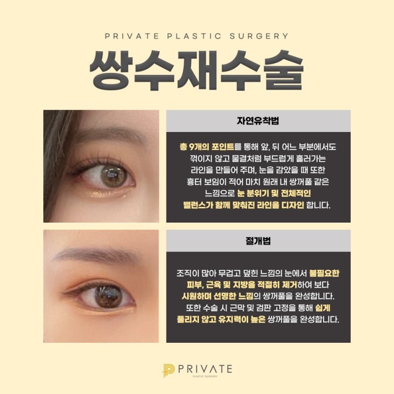 쌍수재수술은 신사 프라이빗성형외과 사진 4