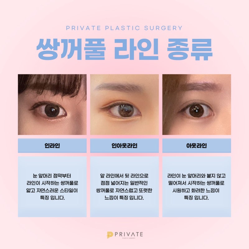 프라이빗성형외과, 쌍꺼풀수술 절개 사진 4