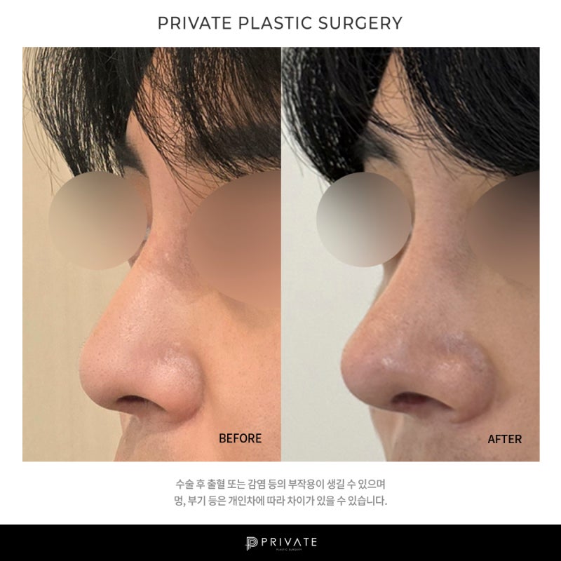 남자 코 재수술 잘하는곳은 신사역 프라이빗성형외과 사진 9
