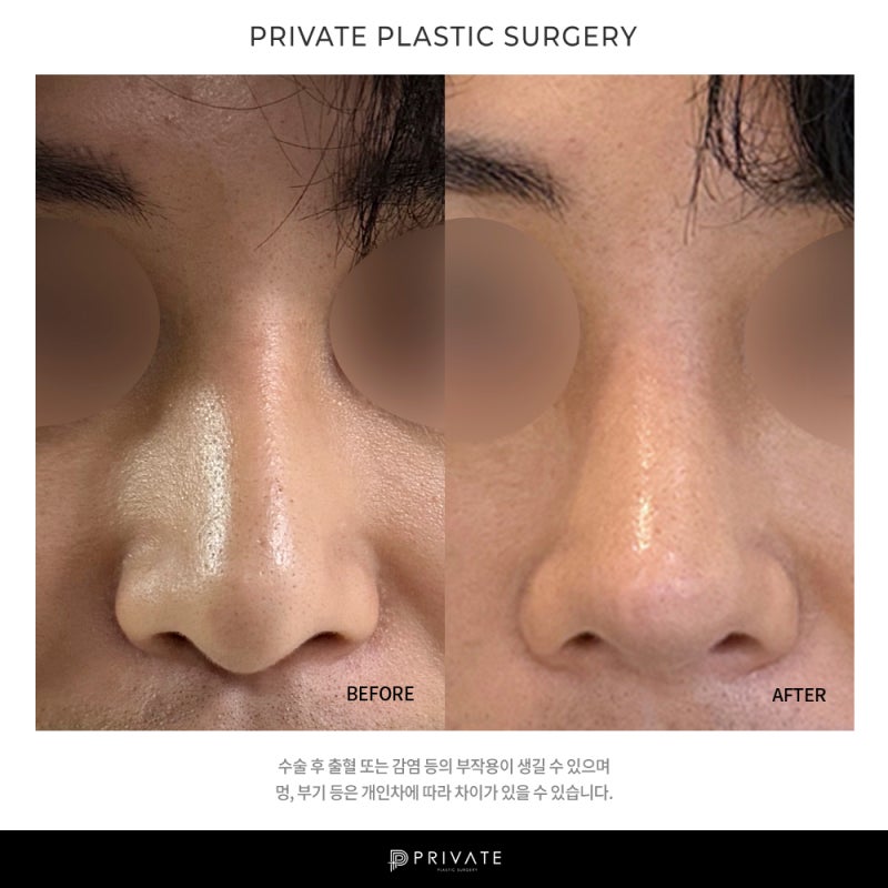 남자 코 재수술 잘하는곳은 신사역 프라이빗성형외과 사진 8