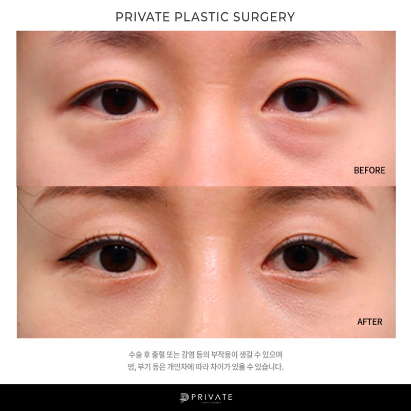 프라이빗 성형외과 눈밑지는? 사진 7