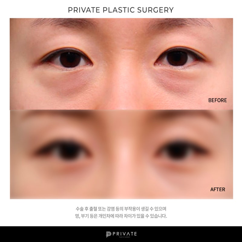 프라이빗 성형외과 눈밑지는? 사진 8