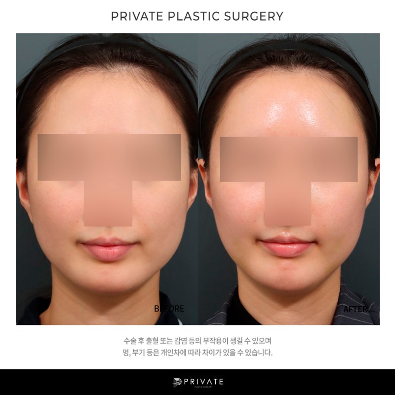 프라이빗 성형외과 지방이식수술 알아보기 사진 8