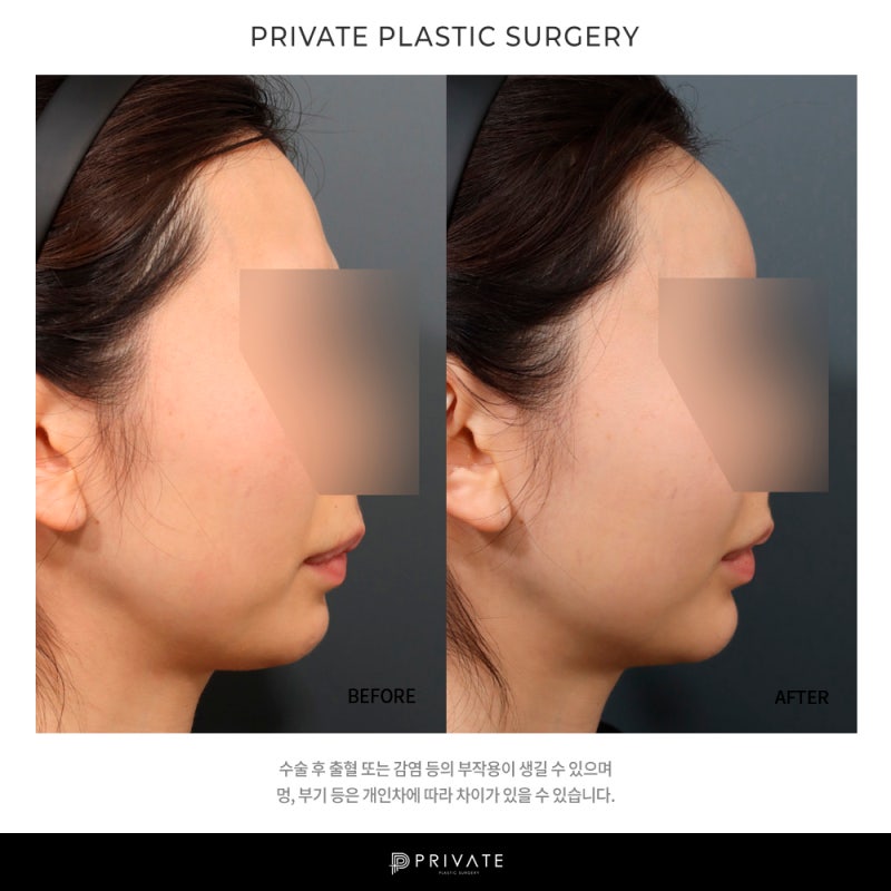 프라이빗 성형외과 지방이식수술 알아보기 사진 7