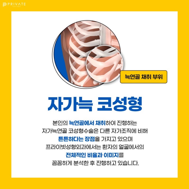 Operasi Rhinoplasty Tulang Rawan Rusuk Autologus Sinsa, Aman dengan Garis yang Elegan