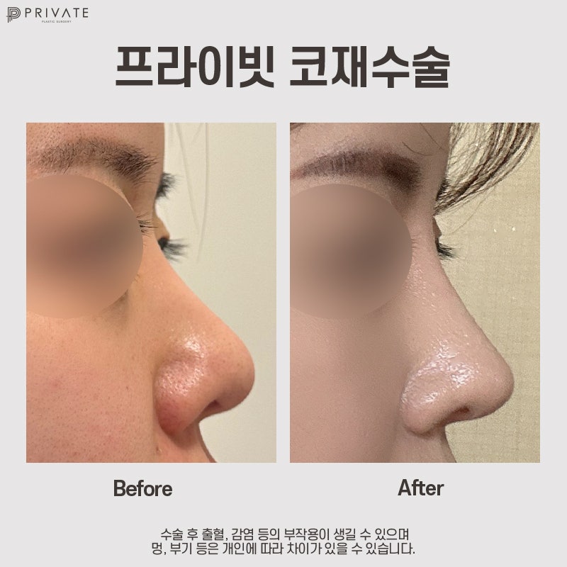 Ulasan Operasi Hidung Revisi di Private Plastic Surgery 사진 8