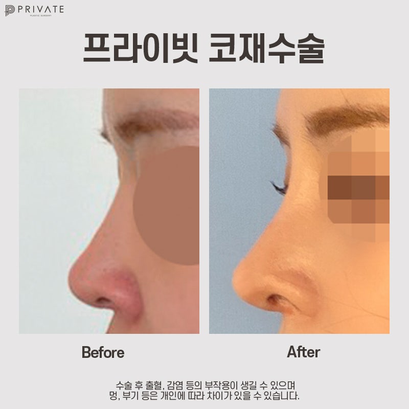 Ulasan Operasi Hidung Revisi di Private Plastic Surgery 사진 2
