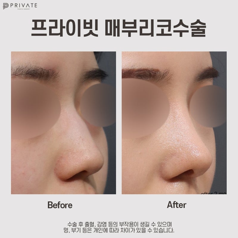 Ринопластика горбинки носа в Private Plastic Surgery 사진 2