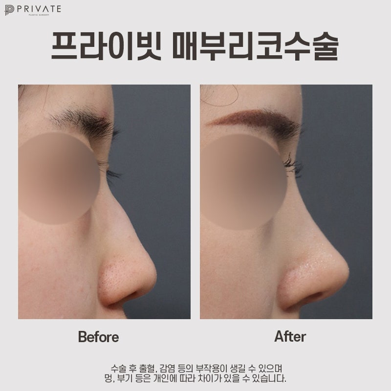 Ринопластика горбинки носа в Private Plastic Surgery 사진 8