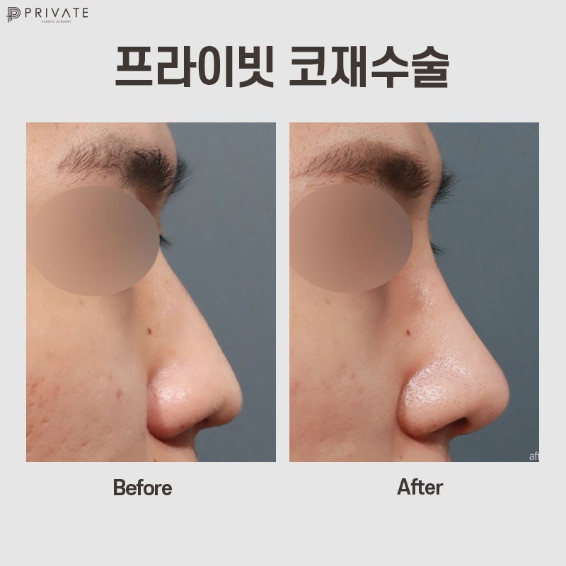 Klinik Bedah Plastik Revisi Hidung adalah Klinik Bedah Plastik Private 사진 9