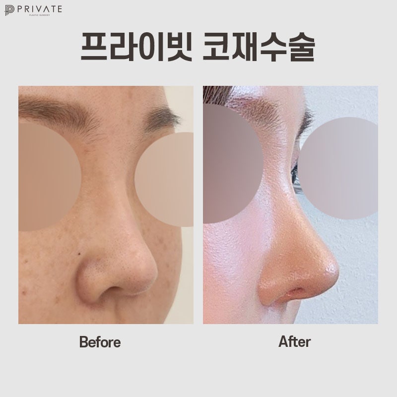 Klinik Bedah Plastik Revisi Hidung adalah Klinik Bedah Plastik Private 사진 2