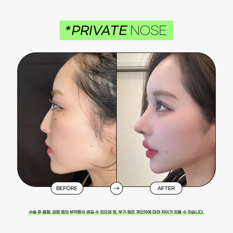 Perekrutan Model Bedah Plastik/Model Nyata di Klinik Bedah Plastik Privat 사진 8