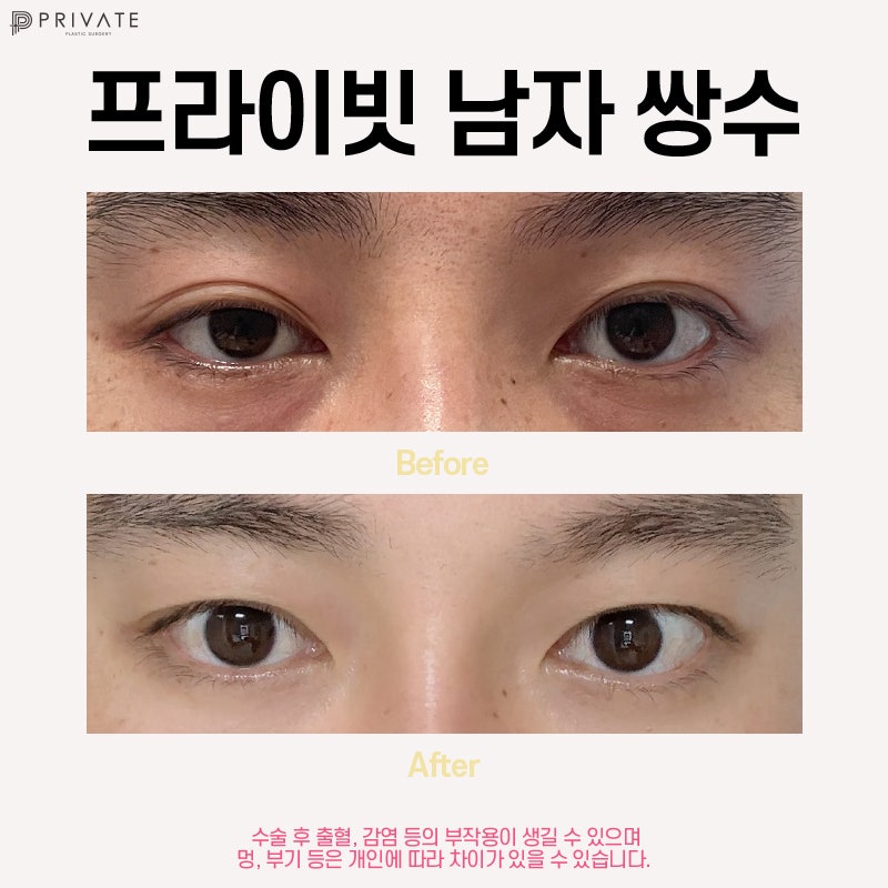 Private Plastic Surgery Clinic: Men's Eye Surgery, Another Choice to Change Your First Impression 사진 5