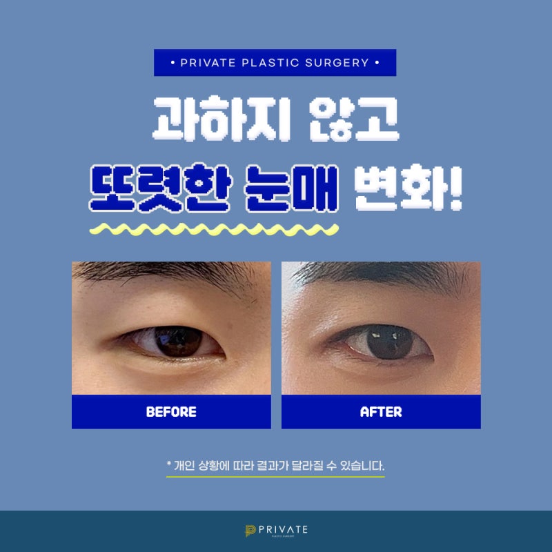 남자쌍수후기좋은곳, 프라이빗성형외과 사진 6