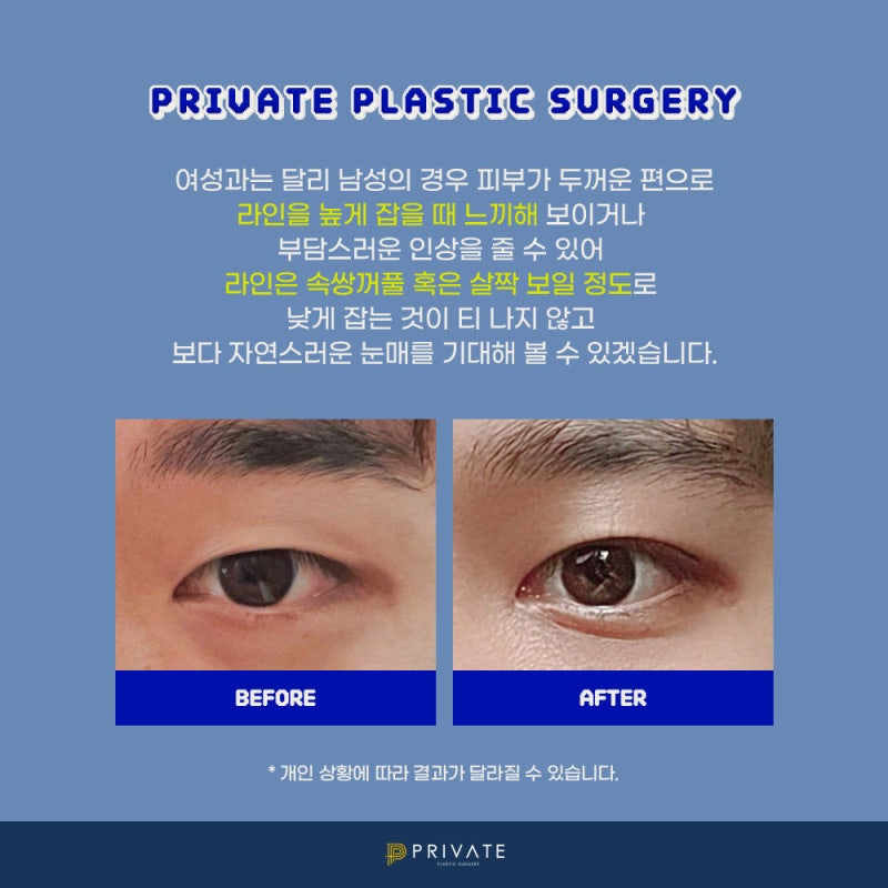 남자쌍수후기좋은곳, 프라이빗성형외과 사진 3