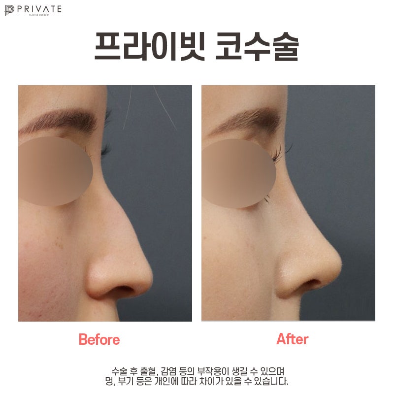 Keajaiban Perubahan Penampilan dengan Koreksi Operasi Hidung Bengkok di Private Plastic Surgery 사진 7