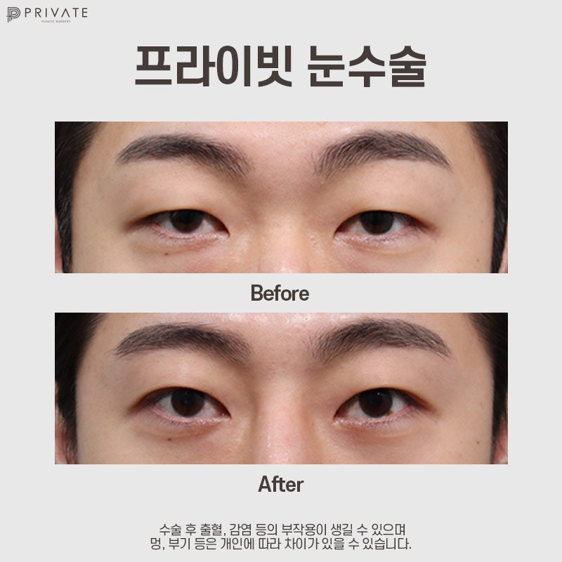 남자 쌍수 절개 수술은 프라이빗성형외과 사진 9
