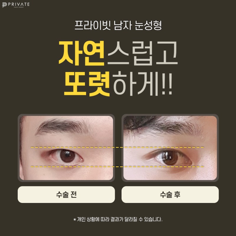남자 쌍수 절개 수술은 프라이빗성형외과 사진 5