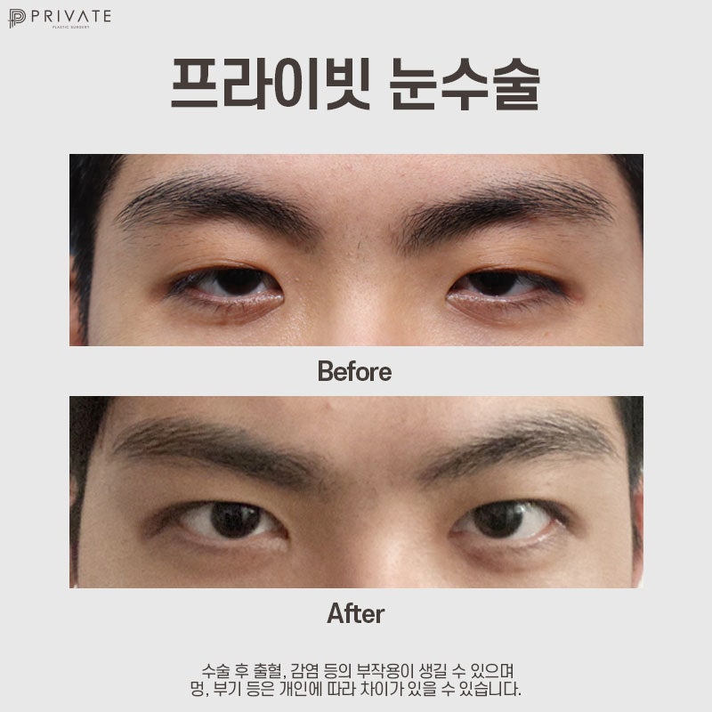 남자 쌍수 절개 수술은 프라이빗성형외과 사진 10