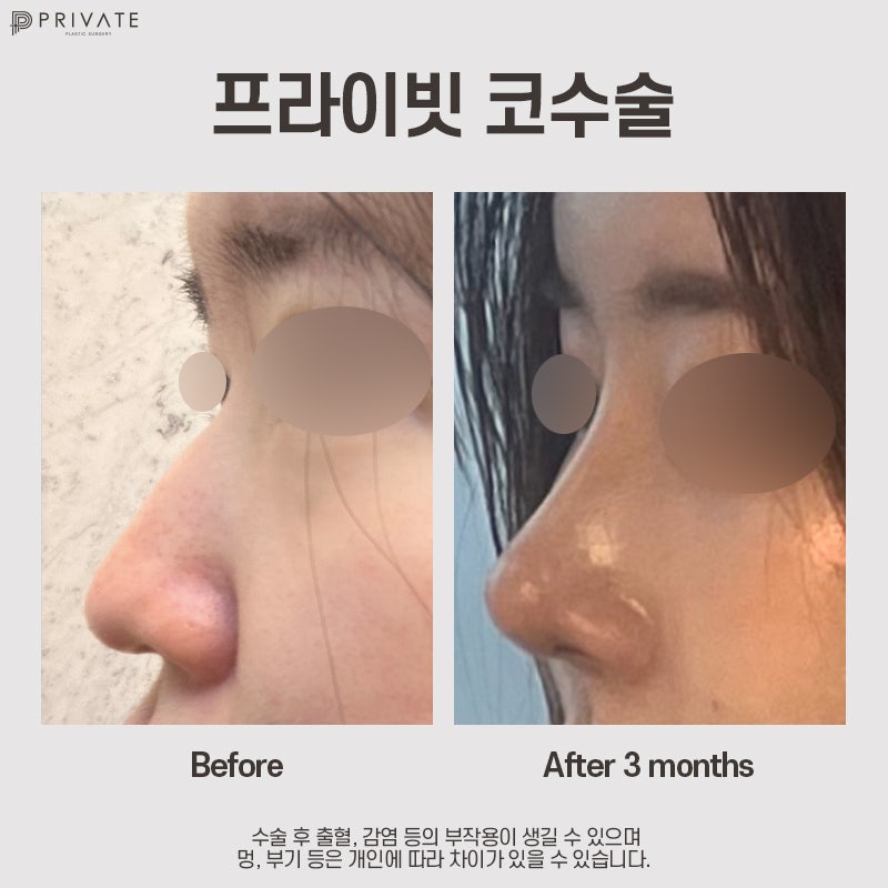 Jika Anda mempertimbangkan operasi hidung dengan tulang rawan iga autologus, Private Plastic Surgery 사진 13