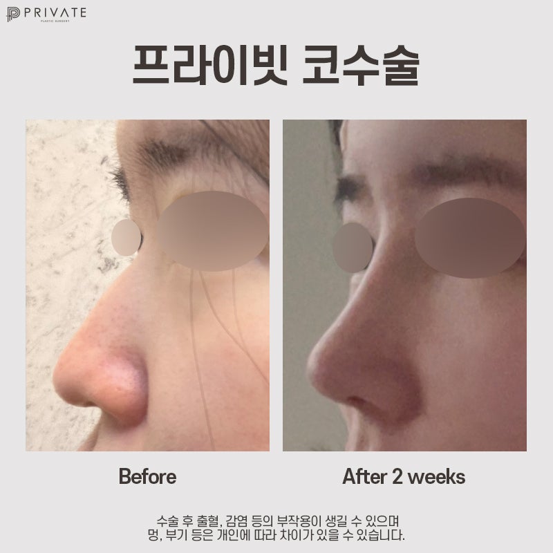 Jika Anda mempertimbangkan operasi hidung dengan tulang rawan iga autologus, Private Plastic Surgery 사진 10