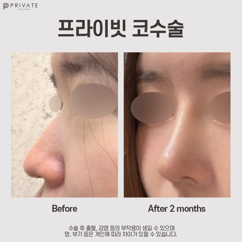 Jika Anda mempertimbangkan operasi hidung dengan tulang rawan iga autologus, Private Plastic Surgery 사진 11