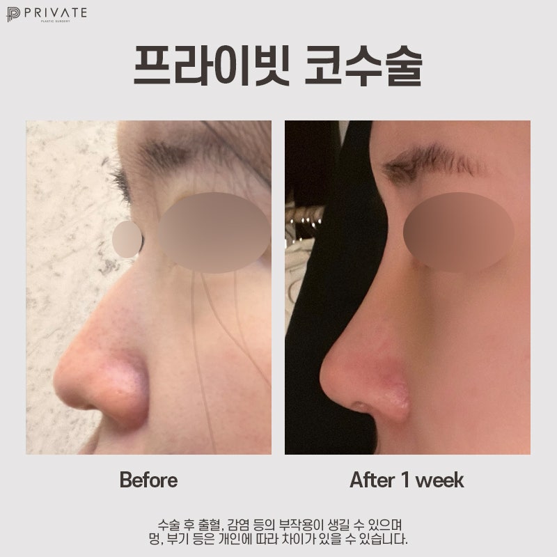 Jika Anda mempertimbangkan operasi hidung dengan tulang rawan iga autologus, Private Plastic Surgery 사진 9