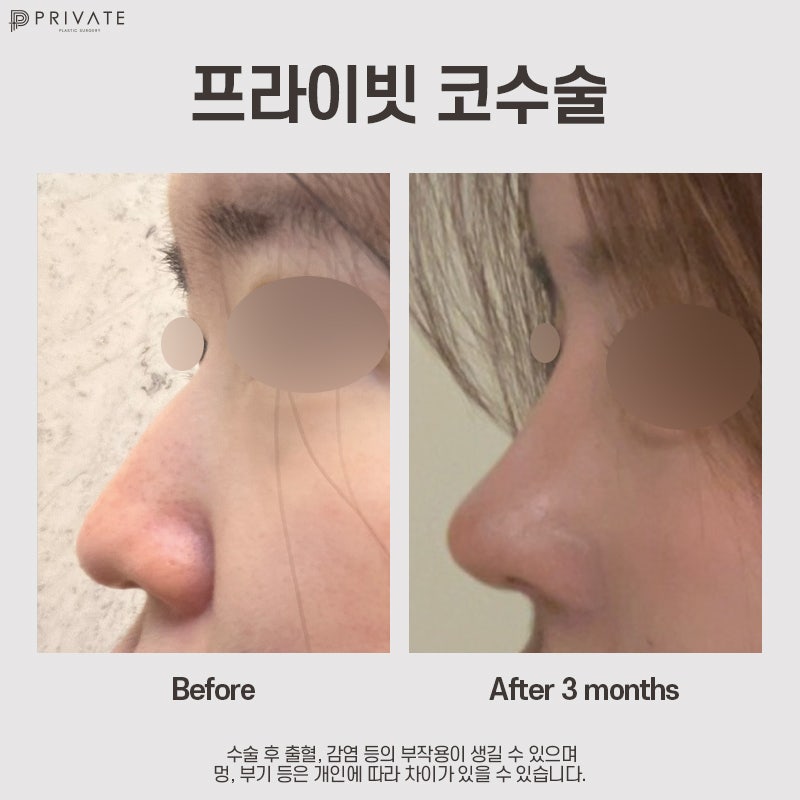 Jika Anda mempertimbangkan operasi hidung dengan tulang rawan iga autologus, Private Plastic Surgery 사진 12