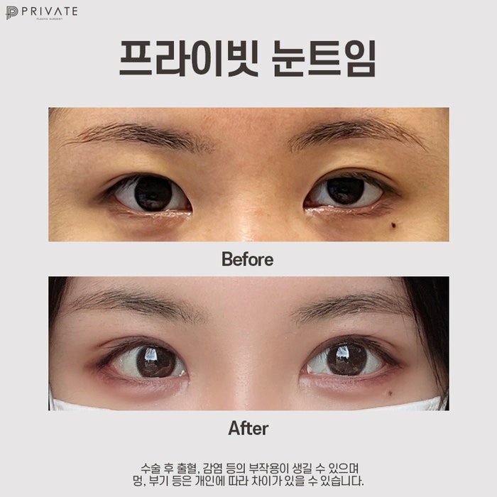 Tempat Terbaik untuk Operasi Mata Terbuka di Sinsa: Private Plastic Surgery Clinic 사진 9