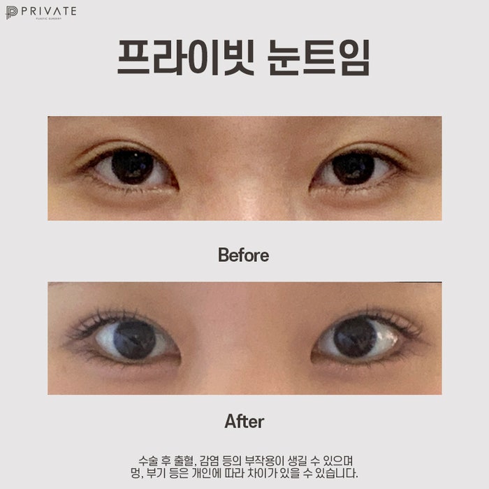 Tempat Terbaik untuk Operasi Mata Terbuka di Sinsa: Private Plastic Surgery Clinic 사진 10