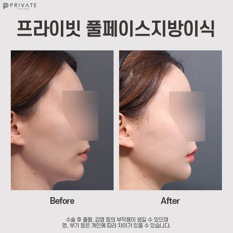 Private Plastic Surgery Clinic dengan Ulasan Bagus untuk Fat Grafting Wajah Penuh 사진 11