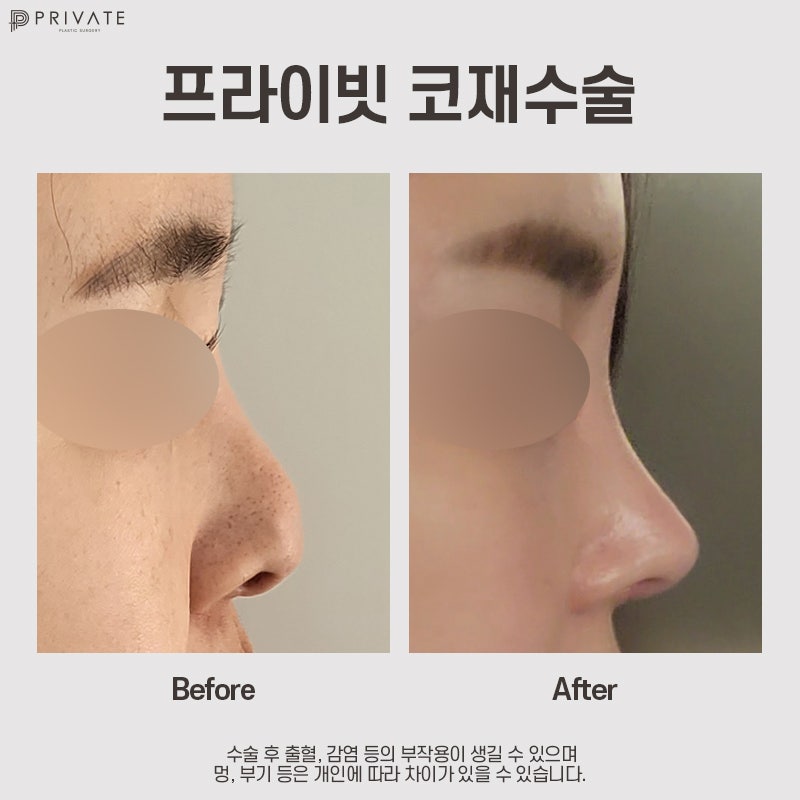 코재수술성형외과 알아보고 있다면? 프라이빗성형외과 사진 8