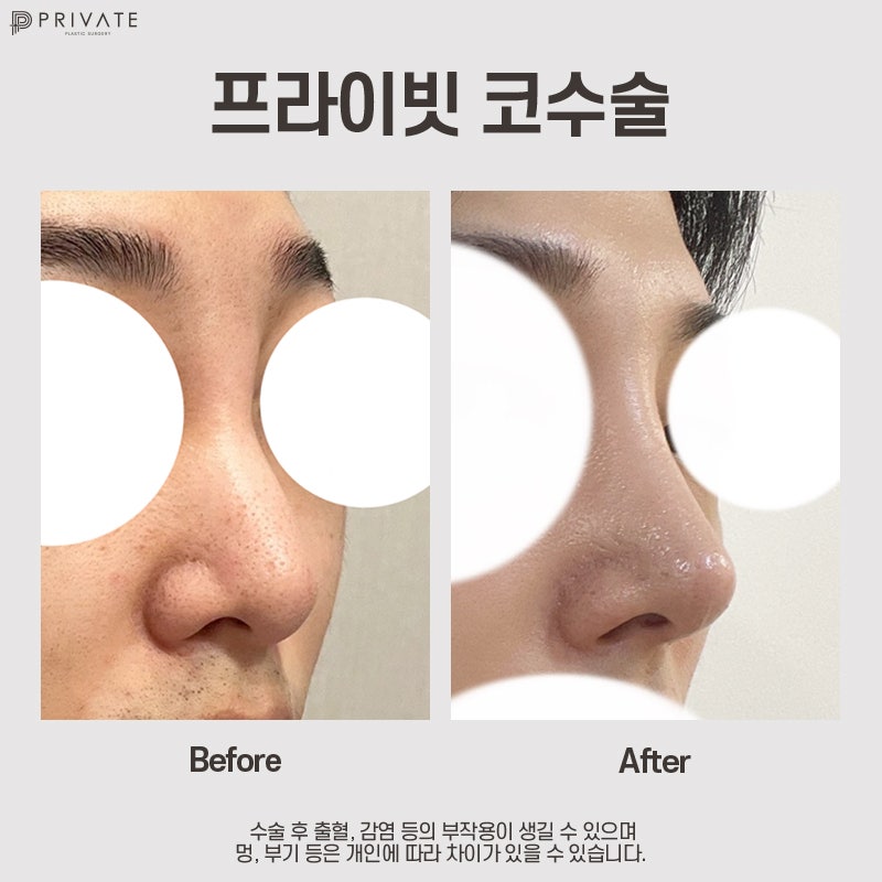 Efek Sebelum dan Sesudah Operasi Hidung Pria yang Baik di Klinik Bedah Plastik Swasta 사진 11