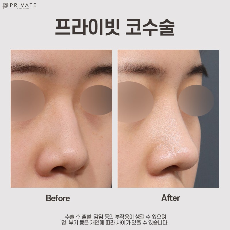 Private Plastic Surgery, Rekomendasi Tempat Bedah Hidung Terbaik 사진 11