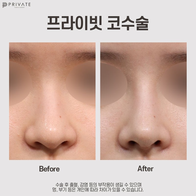 Private Plastic Surgery, Rekomendasi Tempat Bedah Hidung Terbaik 사진 8